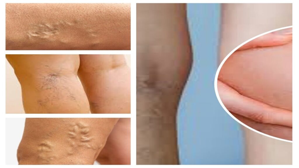 Exercise as a Shield Against Varicose Veins